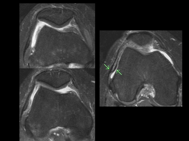 Figure 2 for case iliotibial band ( RID2855 )